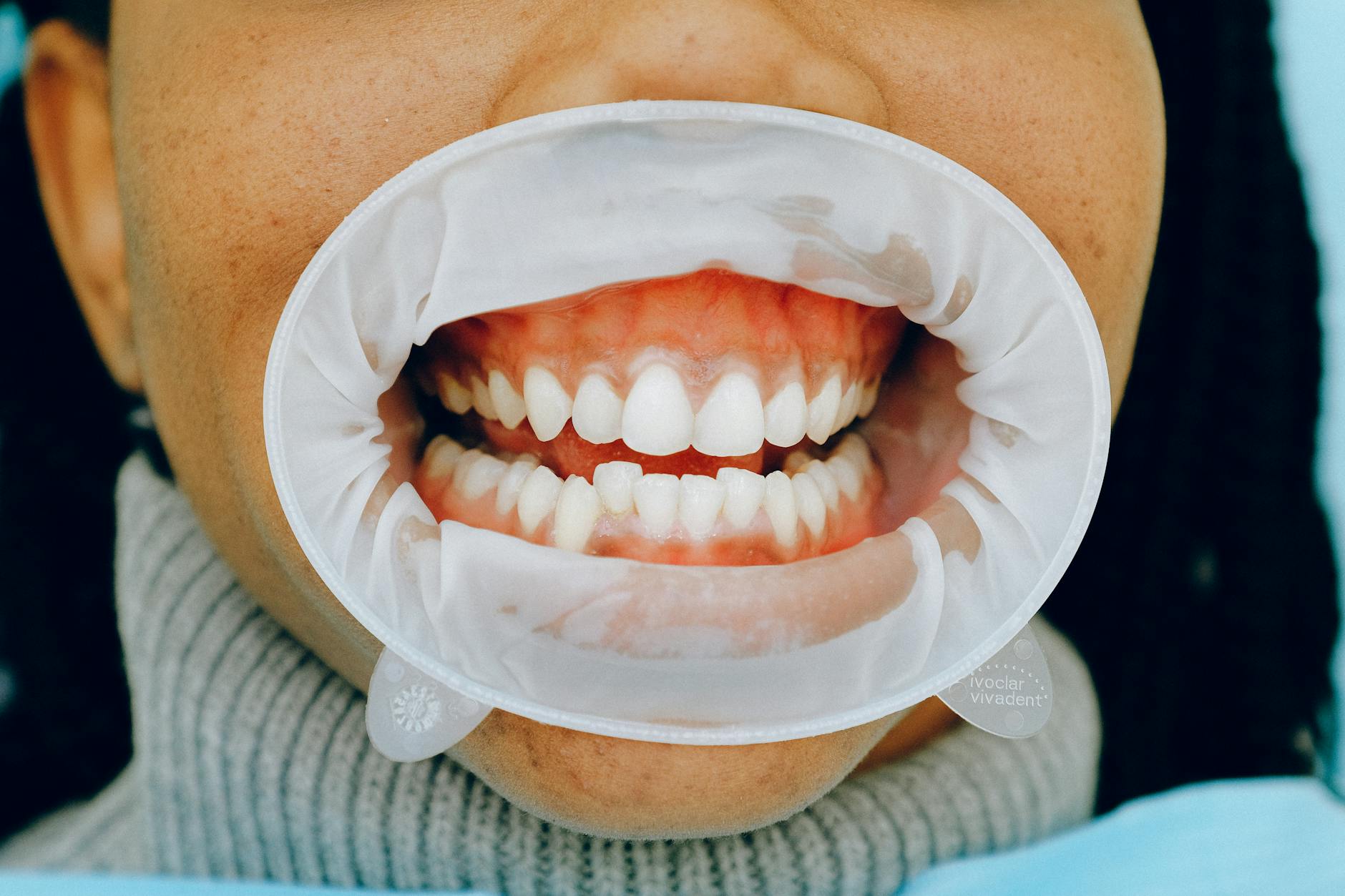 Bruxismo y carillas dentales — compatibilidad y cuidados